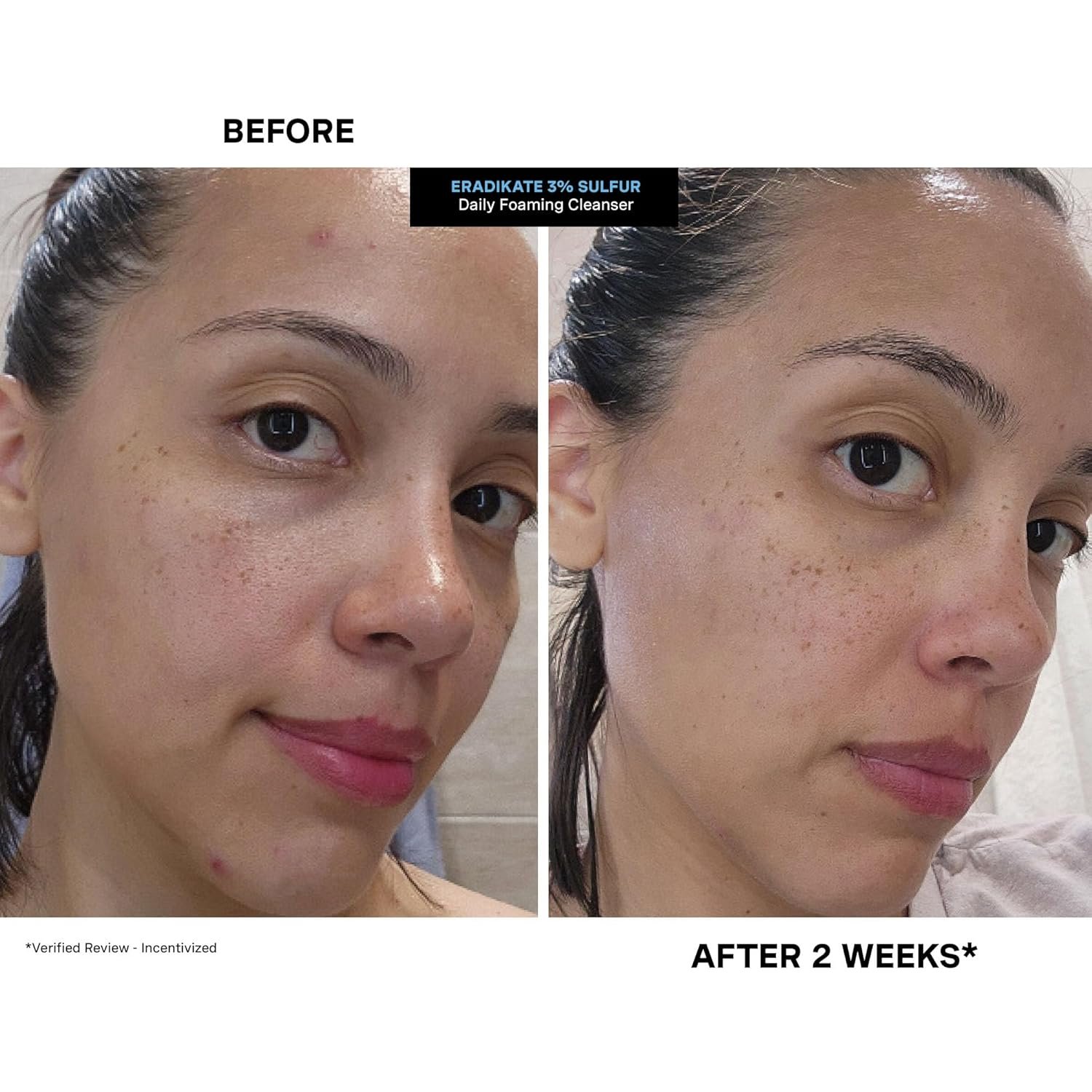 Kate Somerville EradiKate 3% Sulfur Daily Foaming Cleanser Acne Treatment – Clinically Formulated Medicated Face Wash Balances Skin & Cleans Pores, 4 Fl Oz - Image 7